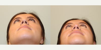 Rhinoplasty before and after photo