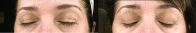 Thermage before and after photo