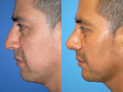 African American Rhinoplasty before and after photo