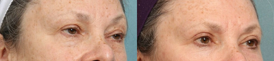 Eyelid Surgery before and after photo