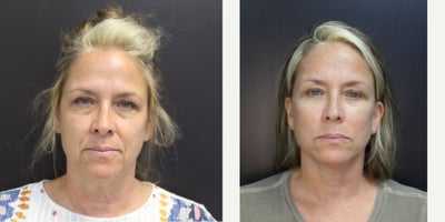 Eyelid Surgery before and after photo