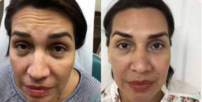 Botox before and after photo