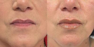 Dermal Fillers before and after photo