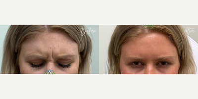 Dysport before and after photo