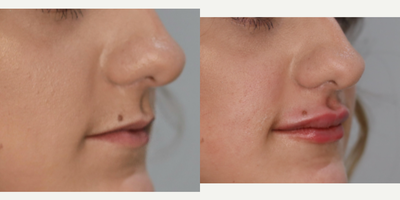 Restylane Silk before and after photo