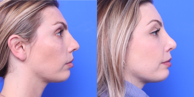 Rhinoplasty before and after photo
