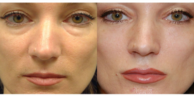 Belotero before and after photo