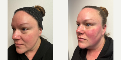 Cheek Fillers before and after photo