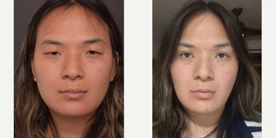 Double Eyelid Surgery before and after photo