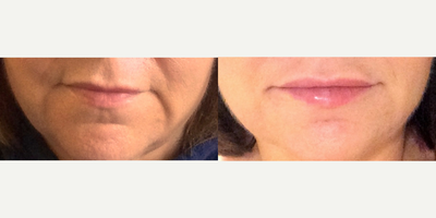 Restylane before and after photo