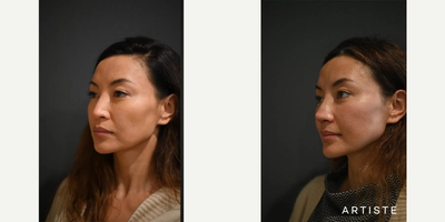 Asian Rhinoplasty before and after photo