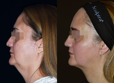 Chin Filler before and after photo