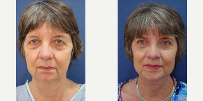 Eyelid Surgery before and after photo