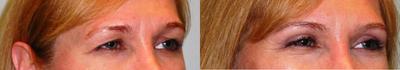 Eyelid Surgery before and after photo
