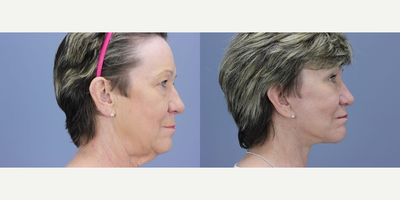 Facelift before and after photo