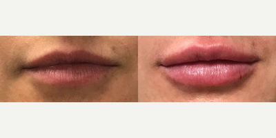 Juvederm before and after photo
