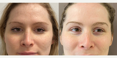 Microneedling before and after photo