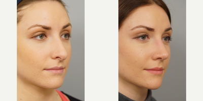 Rhinoplasty before and after photo