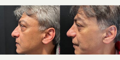 Rhinoplasty before and after photo