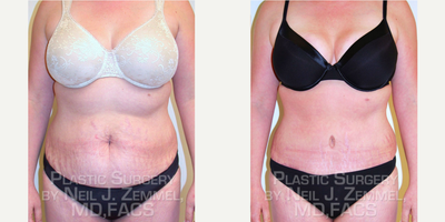 Tummy Tuck before and after photo