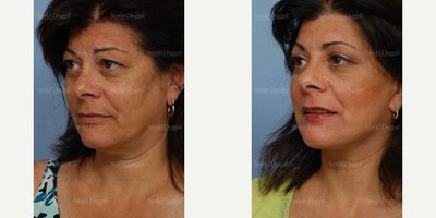 Eyelid Surgery before and after photo