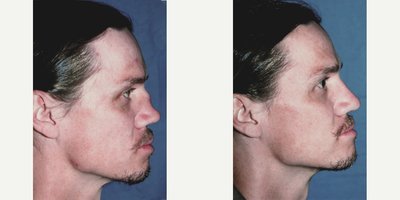 Rhinoplasty before and after photo