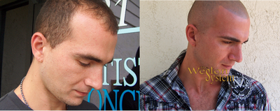 Scalp Micropigmentation before and after photo