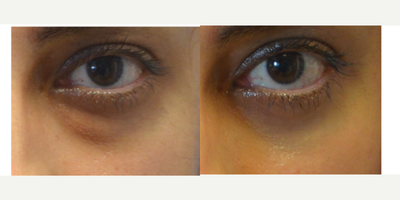 CO2 Laser before and after photo