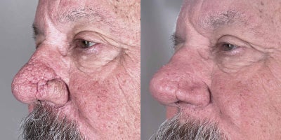 CO2 Laser before and after photo