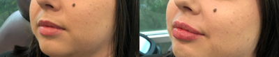 Dermal Fillers before and after photo