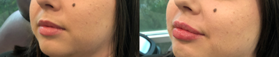 Dermal Fillers before and after photo