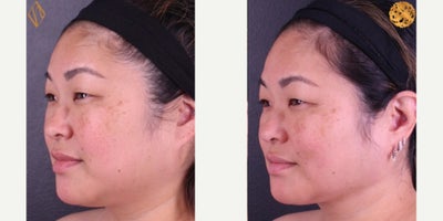 FaceTite before and after photo