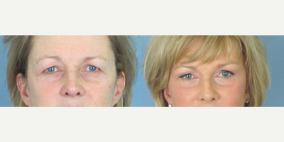 Brow Lift before and after photo
