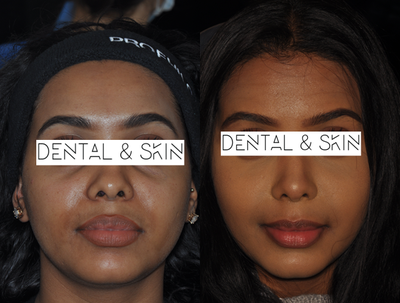 Eyelid Surgery before and after photo