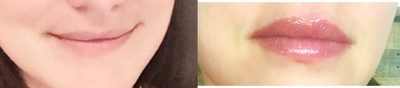 Lip Fillers before and after photo