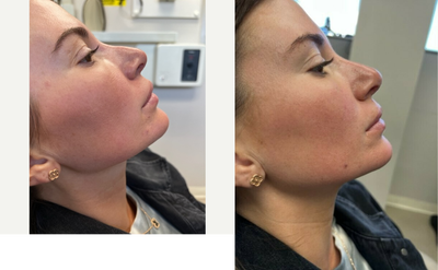 Nonsurgical Nose Job before and after photo