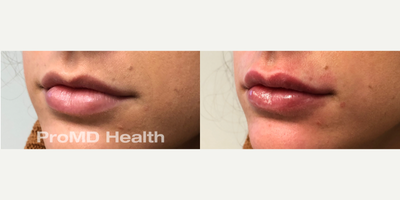 Dermal Fillers before and after photo