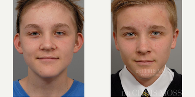 Ear Surgery before and after photo