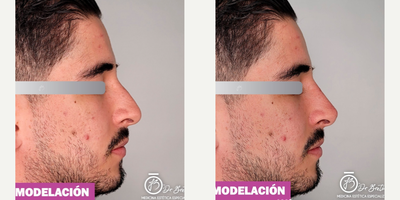 Nonsurgical Nose Job before and after photo