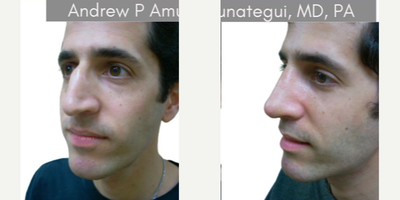 Rhinoplasty before and after photo