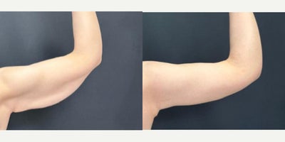 Arm Lift before and after photo