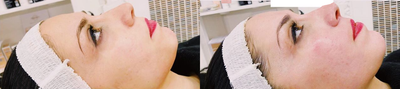 Botox before and after photo