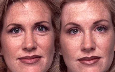 Botox before and after photo
