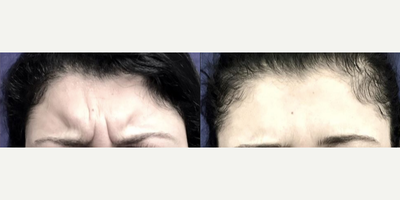 Dysport before and after photo