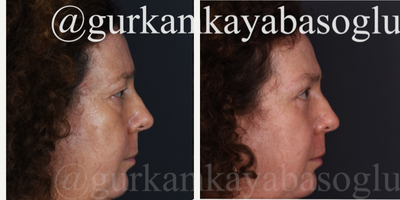 Eyelid Surgery before and after photo
