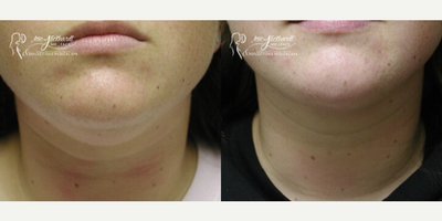 Liposuction before and after photo