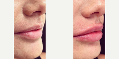 Restylane before and after photo