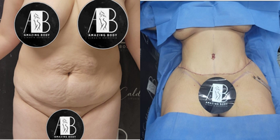 Smart Lipo before and after photo