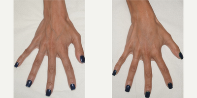 Voluma before and after photo