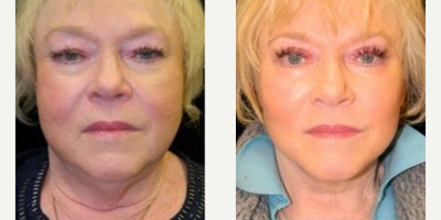 QuickLift before and after photo